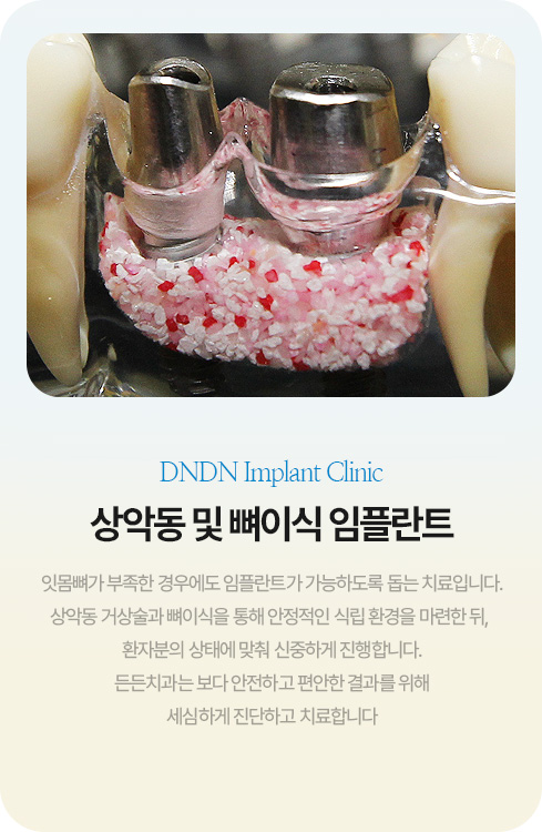 전악 임플란트