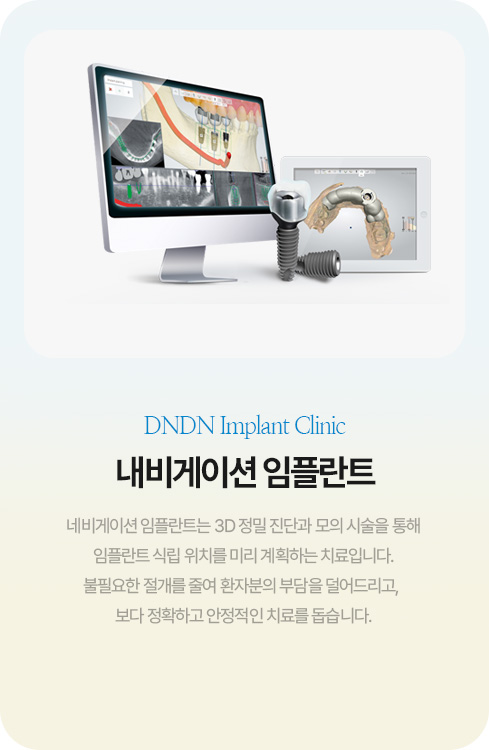 내비게이션 임플란트