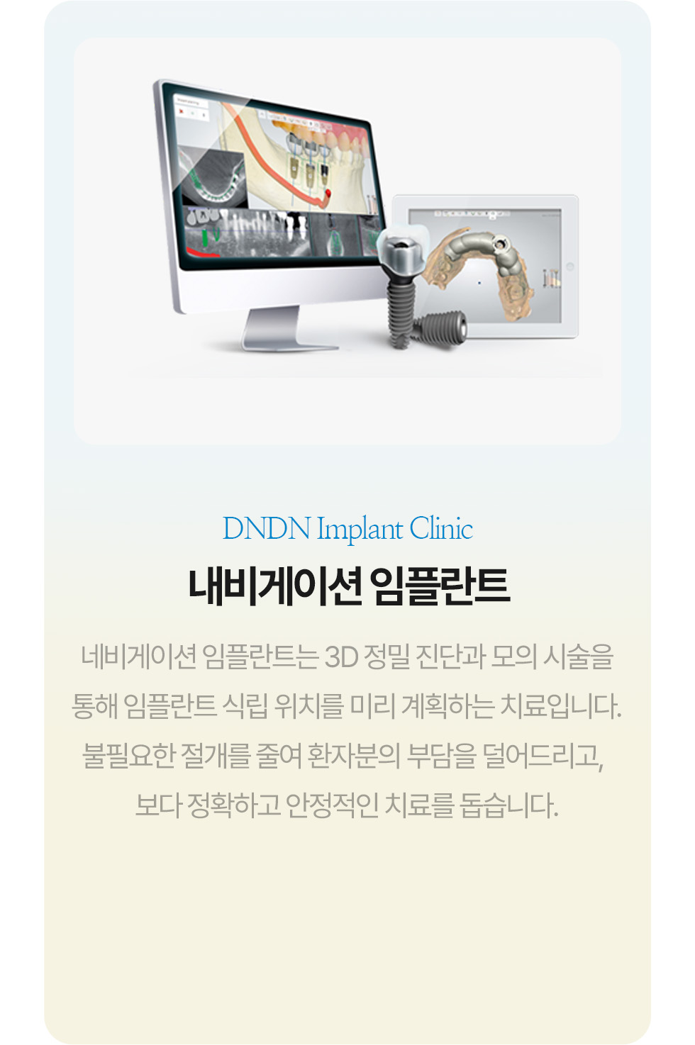 내비게이션 임플란트