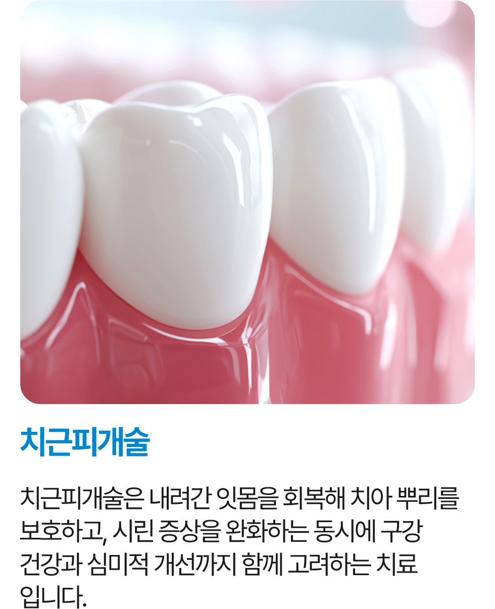 치근피개술