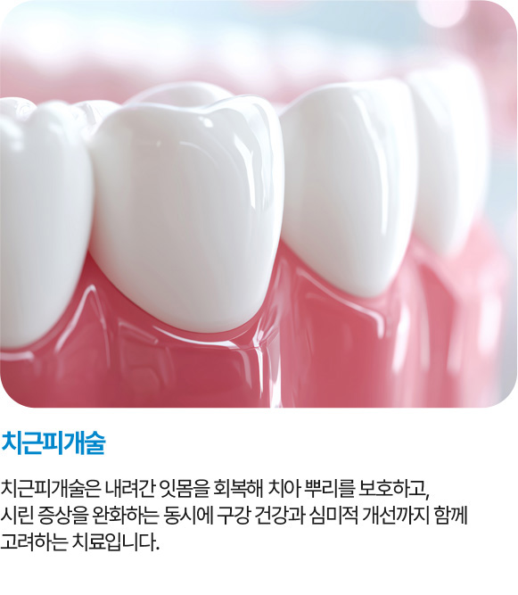 치근피개술
